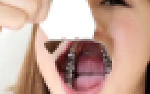綾子ちゃんの歯★★お得な動画＆画像セット★★インレー脱離後、1年放置！立派なクラウン娘