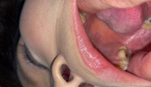 美魔女探訪・熟歯としか言いようのない茶歯＆カブセ ツバキ② KITR00284